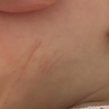 Bebek Tulumunda Güvenlik Açığı Nedeniyle Fiziksel Zarar