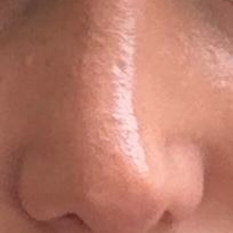 Özel Ekol Hastanesi'nde Burun Ameliyatı Pişmanlığı