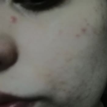 Soltis Güneş Kremi Yüzümde Sivilce Ve Tahrişe Sebep Oldu