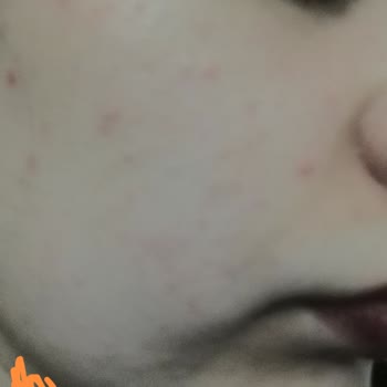 Soltis Güneş Kremi Yüzümde Sivilce Ve Tahrişe Sebep Oldu