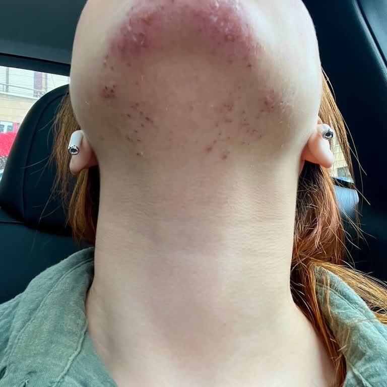 İğneli Epilasyon Yanığı: Yüzümde Kalıcı Hasar Oluştu!