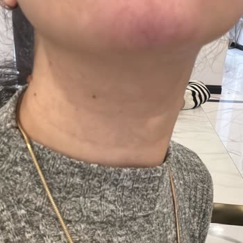 Çene Dolgusu Sonrası Yaşanan Sağlık Sorunları Ve Klinik İlgisizliği