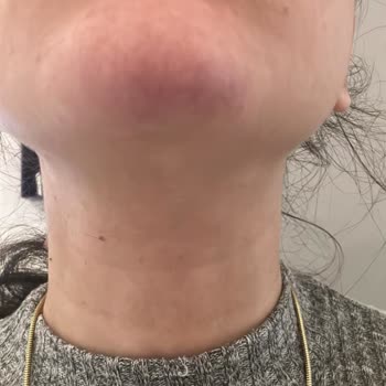 Çene Dolgusu Sonrası Yaşanan Sağlık Sorunları Ve Klinik İlgisizliği