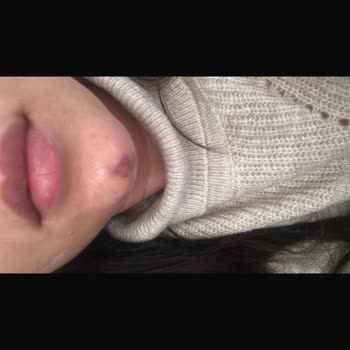 Çene Dolgusu Sonrası Yaşanan Sağlık Sorunları Ve Klinik İlgisizliği