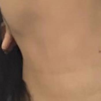 Çene Dolgusu Sonrası Yaşanan Sağlık Sorunları Ve Klinik İlgisizliği