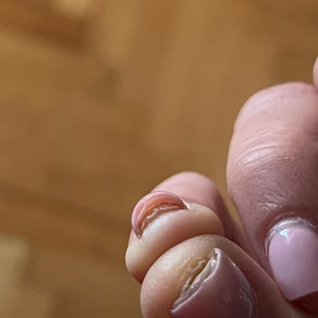 Protez Tırnak Sonrası Mantar Enfeksiyonu Ve İlgisiz İşletme Mağduriyeti