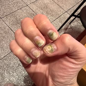 Protez Tırnak Sonrası Mantar Enfeksiyonu Ve İlgisiz İşletme Mağduriyeti