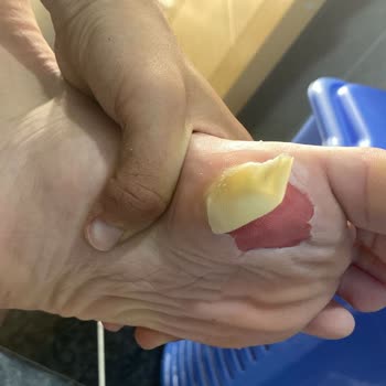 Krampon Yaraları Yüzünden Oğlum Sınavlarına Gidemiyor!