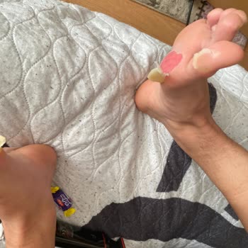 Krampon Yaraları Yüzünden Oğlum Sınavlarına Gidemiyor!