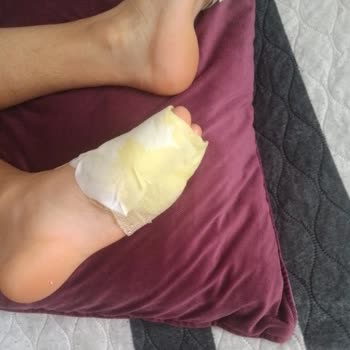 Krampon Yaraları Yüzünden Oğlum Sınavlarına Gidemiyor!