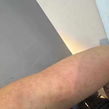 Duru Body Scrub Duş Jeli Ciltte Tahriş Ve Sivilce Sorunu Yaşattı