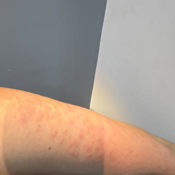 Duru Body Scrub Duş Jeli Ciltte Tahriş Ve Sivilce Sorunu Yaşattı