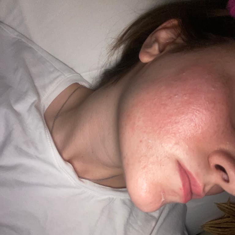 The Purest Glikolik Asit Ve C Vitamini Ürünü Cildimde Alerjik Reaksiyona Sebep Oldu