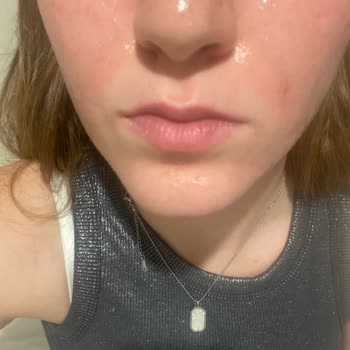 The Purest Glikolik Asit Ve C Vitamini Ürünü Cildimde Alerjik Reaksiyona Sebep Oldu