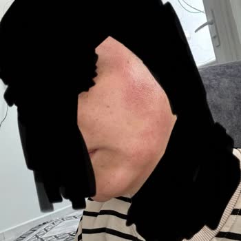 Gratis Bee Beauty Kağıt Yüz Maskesi Cildimde Alerji ve Tahrişe Sebep Oldu