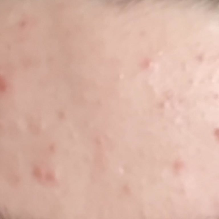 Yves Rocher Yıkama Jeli Cildimi Mahvetti, Sivilce Yaptı