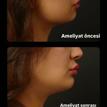 Yanlış Aparat, Umursamaz Tavır: Çene Ameliyatım Kabusa Döndü