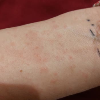 Alerjiye Neden Olan Krem Sonrası İlgisiz Müşteri Hizmetleriyle Mağduriyet Yaşadım