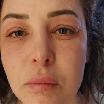 Alerjiye Neden Olan Krem Sonrası İlgisiz Müşteri Hizmetleriyle Mağduriyet Yaşadım