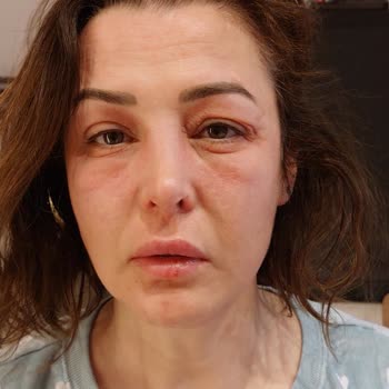 Yves Rocher Elixir Botanique SPF 50 Gave Me a Severe Allergy