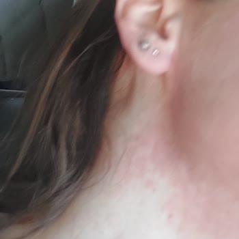 Yves Rocher Elixir Botanique SPF 50 Gave Me a Severe Allergy