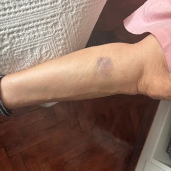 Yanlış Karyola Parçası Ve Süreçte Yaşanan Mağduriyet