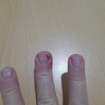 Protez Tırnak Sonrası Enfeksiyon Ve Hijyen Eksikliği Şok Etti