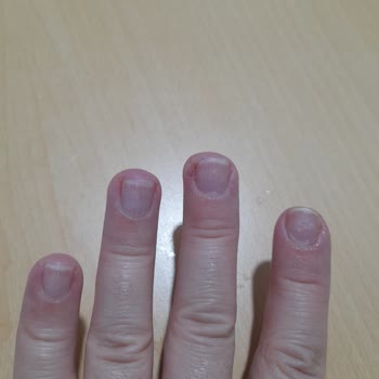 Protez Tırnak Sonrası Enfeksiyon Ve Hijyen Eksikliği Şok Etti