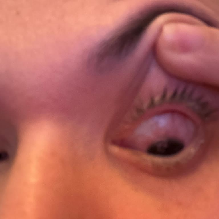 Labella Soft Clear Lens Gözümde Alerji Ve Enfeksiyona Yol Açtı