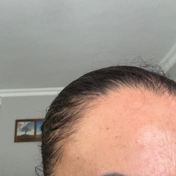 Fatih Sarıkaya Kuaför'de İşlem Sonuçları Korkunç