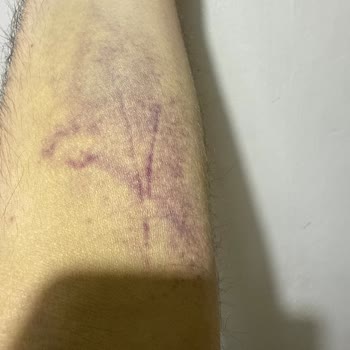 Türk Kızılay Kan Bağışı Sonrası Kolumda Morluk Ve Ağrı Geçmiyor