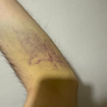 Türk Kızılay Kan Bağışı Sonrası Kolumda Morluk Ve Ağrı Geçmiyor