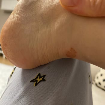 Kısa Sürede Ayakta Yaralara Sebep Olan Ayakkabının Hayal Kırıklığı