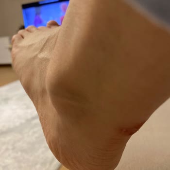 Kısa Sürede Ayakta Yaralara Sebep Olan Ayakkabının Hayal Kırıklığı