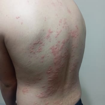 Çocuğum Macrol 500 Mg İlacı Sonrası Ciddi Yan Etki Yaşadı