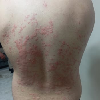 Çocuğum Macrol 500 Mg İlacı Sonrası Ciddi Yan Etki Yaşadı