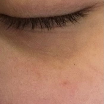 Maskara Gözümde Arpacık Ve Şiddetli Hassasiyet Yaptı Sosyal Hayatım Etkilendi