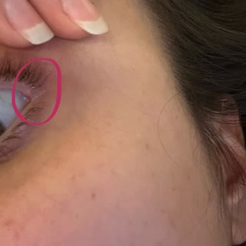 Maskara Gözümde Arpacık Ve Şiddetli Hassasiyet Yaptı Sosyal Hayatım Etkilendi