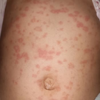 Doktorun Uygunsuz İlaç Tedavisi Nedeniyle Kızımda Alerjik Reaksiyon Gelişti