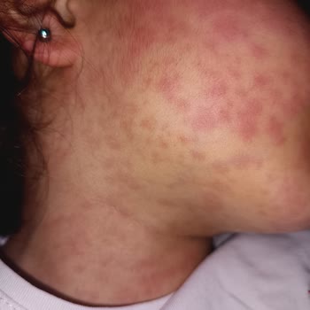 Doktorun Uygunsuz İlaç Tedavisi Nedeniyle Kızımda Alerjik Reaksiyon Gelişti