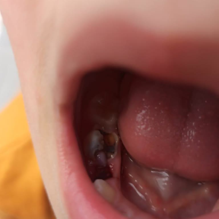 Çocuğumun Sağlam Dişi Yanlışlıkla Çekildi