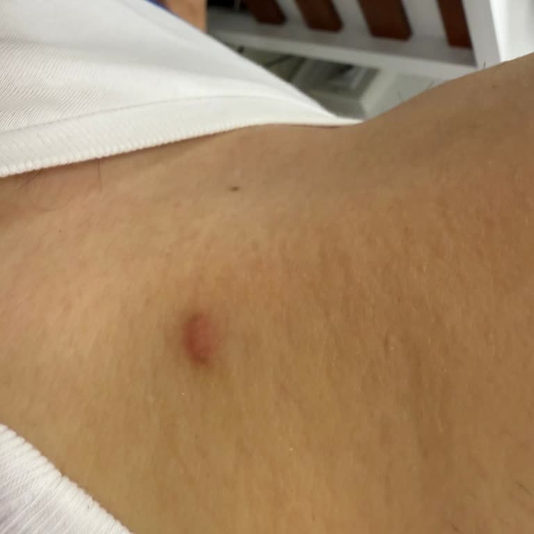 Koter İşleminden Sonra Omzumda Kalıcı İz Kalmasından Endişeliyim