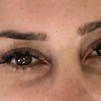 Clinimed Göz Altı Dolgu İşleminden Sonra Artan Çöküklük Ve Memnuniyetsizlik