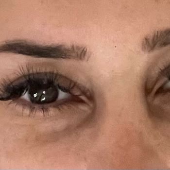 Clinimed Göz Altı Dolgu İşleminden Sonra Artan Çöküklük Ve Memnuniyetsizlik