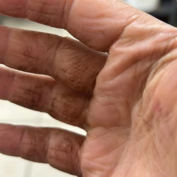 Eczane Ürünü Yüzümde Ve Vücudumda Kalıcı Hasara Yol Açtı