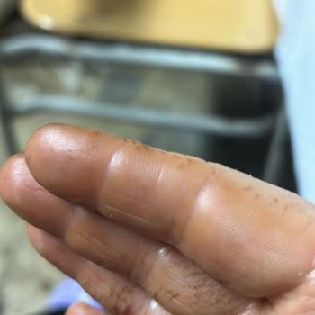 Eczane Ürünü Yüzümde Ve Vücudumda Kalıcı Hasara Yol Açtı