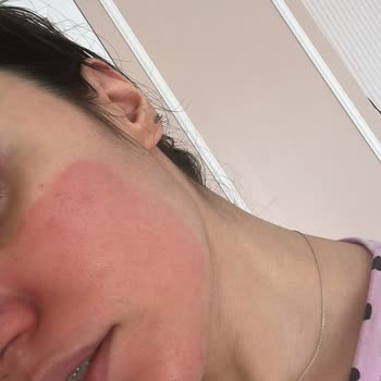 Neutrogena Deep Clean Peeling Sonrası Cilt Sorunu Ve İlgisizlik