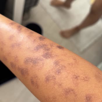 Lazer Epilasyon Sonrası Yanık Ve İlgisiz Yaklaşım