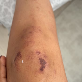 Lazer Epilasyon Sonrası Yanık Ve İlgisiz Yaklaşım