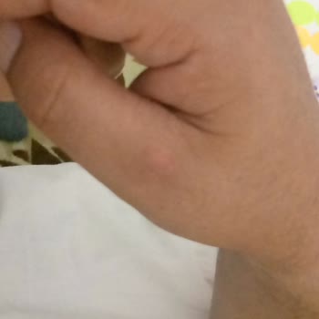 Dyson V8 Süpürge Kullanımında Yanık Ve Güvenlik Sorunu